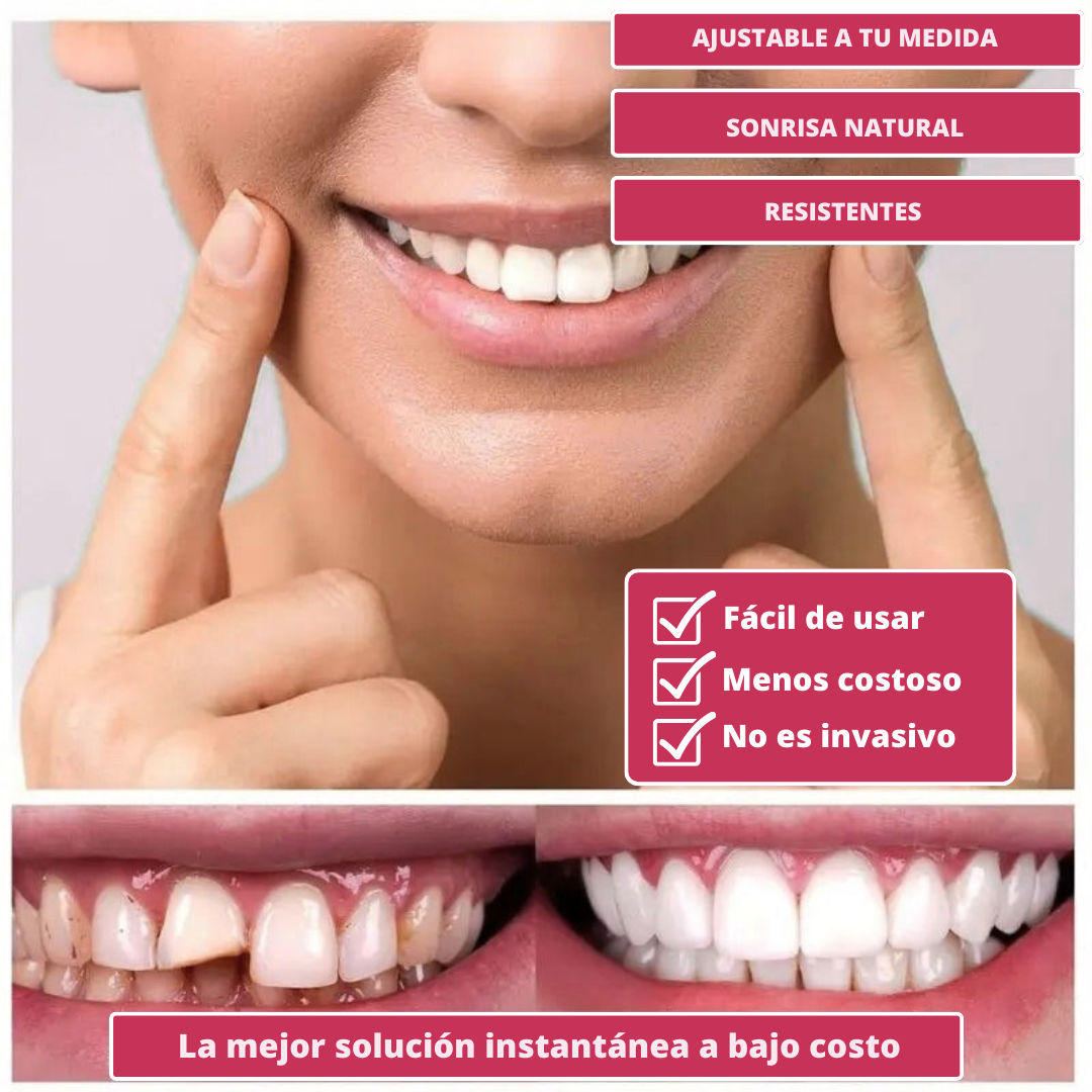 Carillas Dentales Snap-On Smile – Sonrisa Más Atractiva al Instante