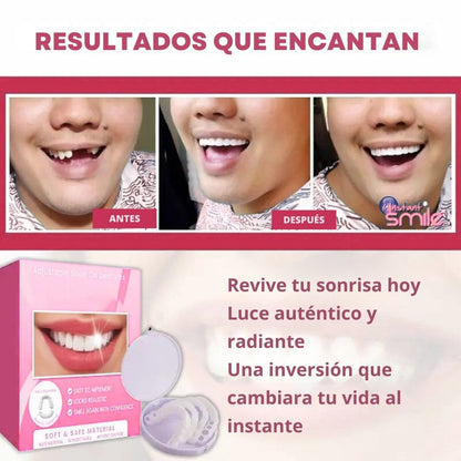 Carillas Dentales Snap-On Smile – Sonrisa Más Atractiva al Instante