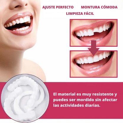 Carillas Dentales Snap-On Smile – Sonrisa Más Atractiva al Instante